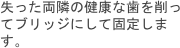 失った両隣の健康な歯を削ってブリッジにして固定します。